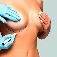 Creating Realistic Expectations for a Breast Lift