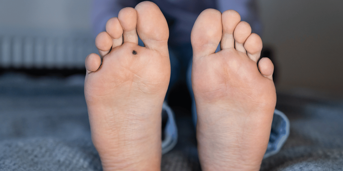 Effective Treatments for Plantar Warts You Need to Know