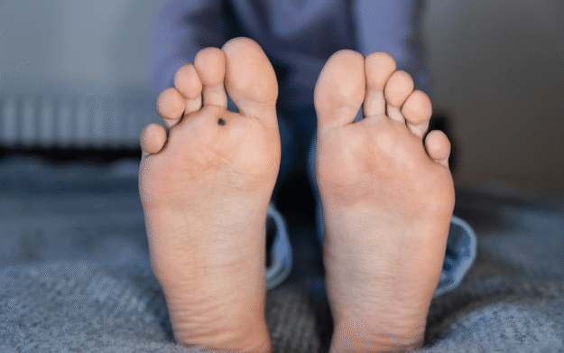Effective Treatments for Plantar Warts You Need to Know