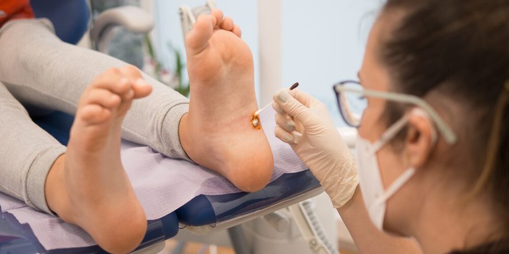 Exploring the Latest Treatments for Plantar Warts Exploring the Latest Treatments for Plantar Warts