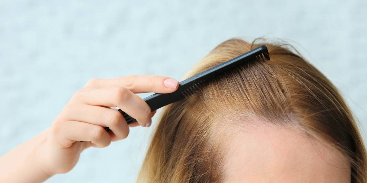 Hair Loss Treatments and What Options Are Available