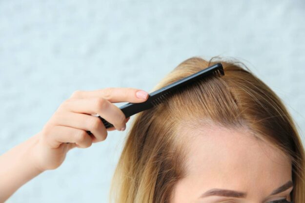 Hair Loss Treatments and What Options Are Available