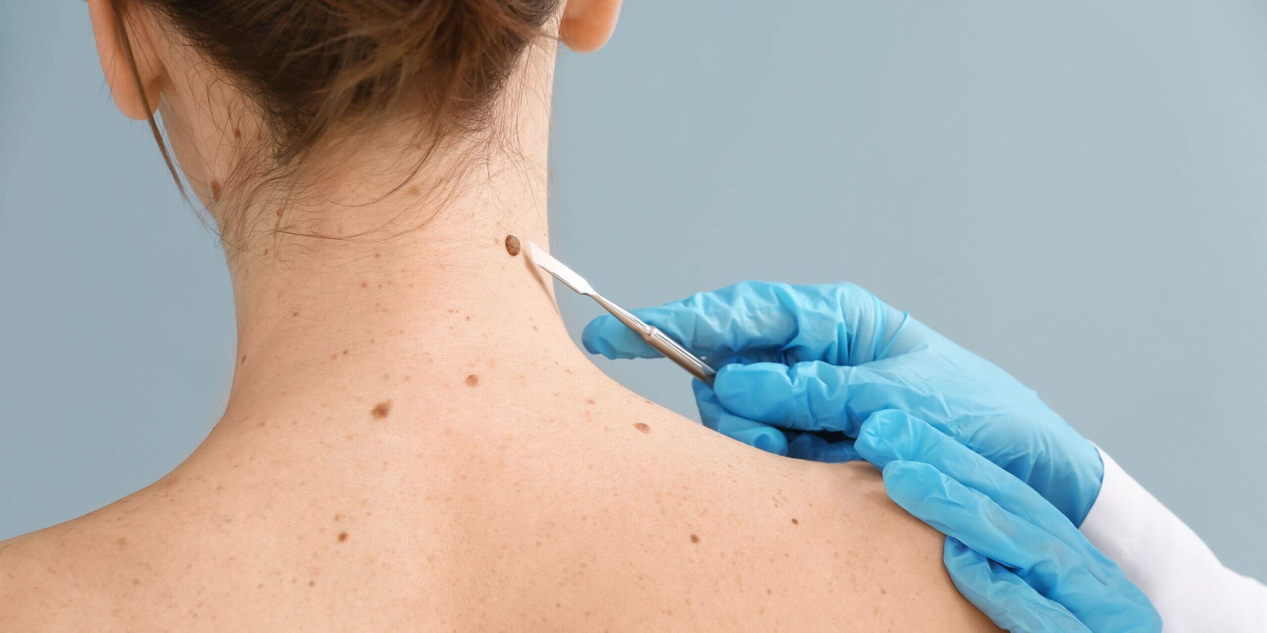 How is Skin Cancer Diagnosed?