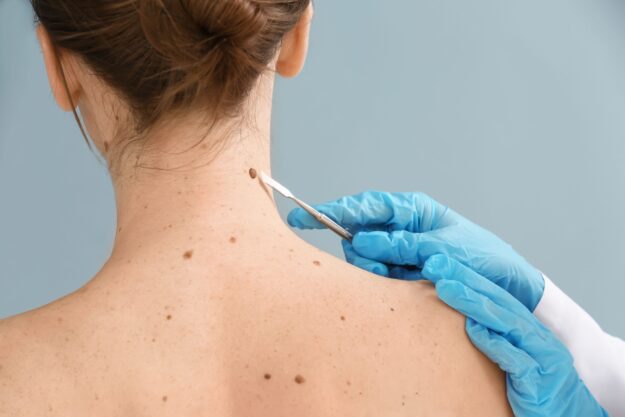 How is Skin Cancer Diagnosed?