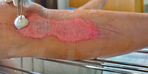 Key Elements of Wound Care for Seniors