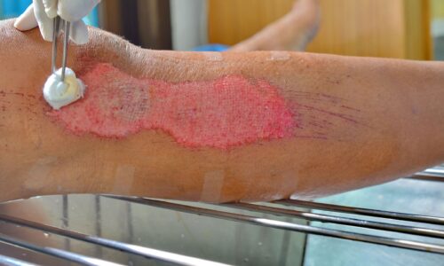 Key Elements of Wound Care for Seniors