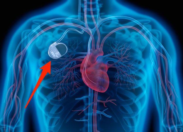 Questions To Ask Your Doctor About Pacemakers