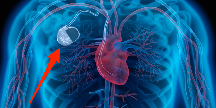 Questions To Ask Your Doctor About Pacemakers