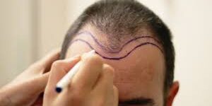 The Different Methods of Hair Restoration Explained