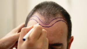 The Different Methods of Hair Restoration Explained The Different Methods of Hair Restoration Explained