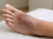 Solutions for Managing Bunions