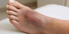 Solutions for Managing Bunions