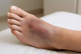 Solutions for Managing Bunions