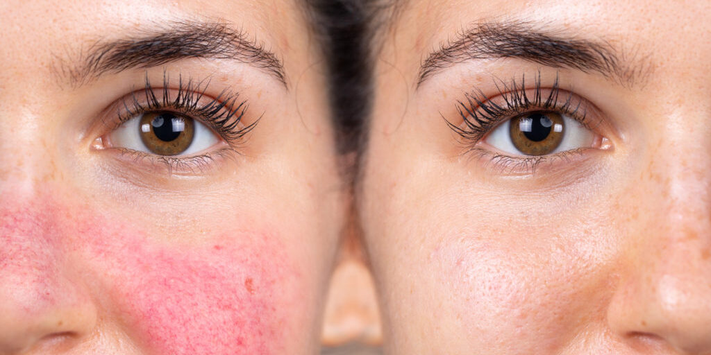 Understanding Hyperpigmentation and Treatment Options From a Dermatologist