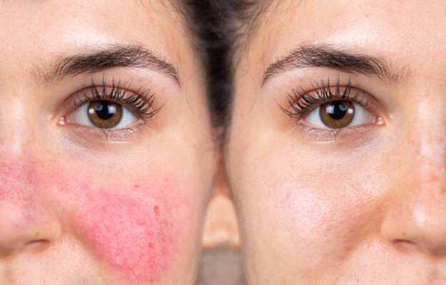 Understanding Hyperpigmentation and Treatment Options From a Dermatologist