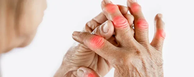Understanding the Stages of Arthritis and Their Symptoms