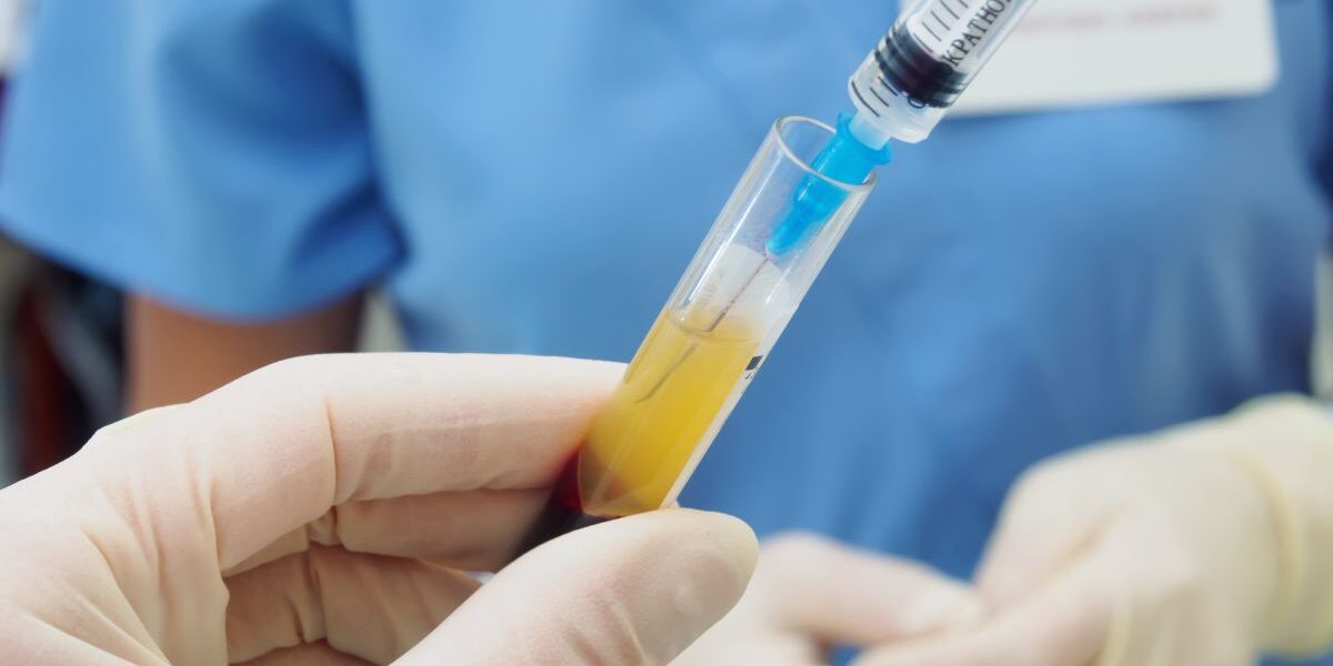 Using PRP for Sports Injuries