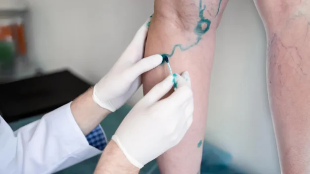 How To Maximize Your Experience at a Vein Clinic