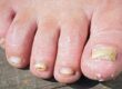How to Prevent Fungal Nails