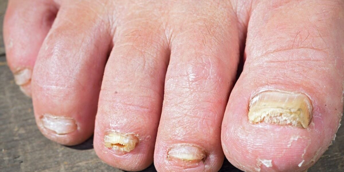 How to Prevent Fungal Nails