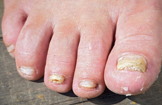 How to Prevent Fungal Nails