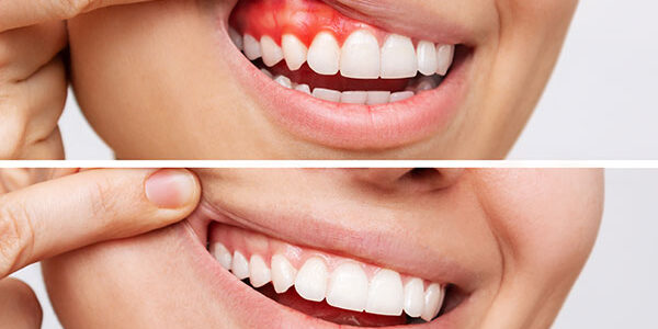 Understanding Periodontal Disease And Its Impact On Oral Health