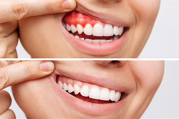 Understanding Periodontal Disease And Its Impact On Oral Health