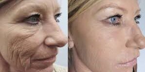 What to Expect from Platelet Rich Plasma Therapy Sessions What to Expect from Platelet Rich Plasma Therapy Sessions