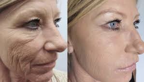 What to Expect from Platelet Rich Plasma Therapy Sessions