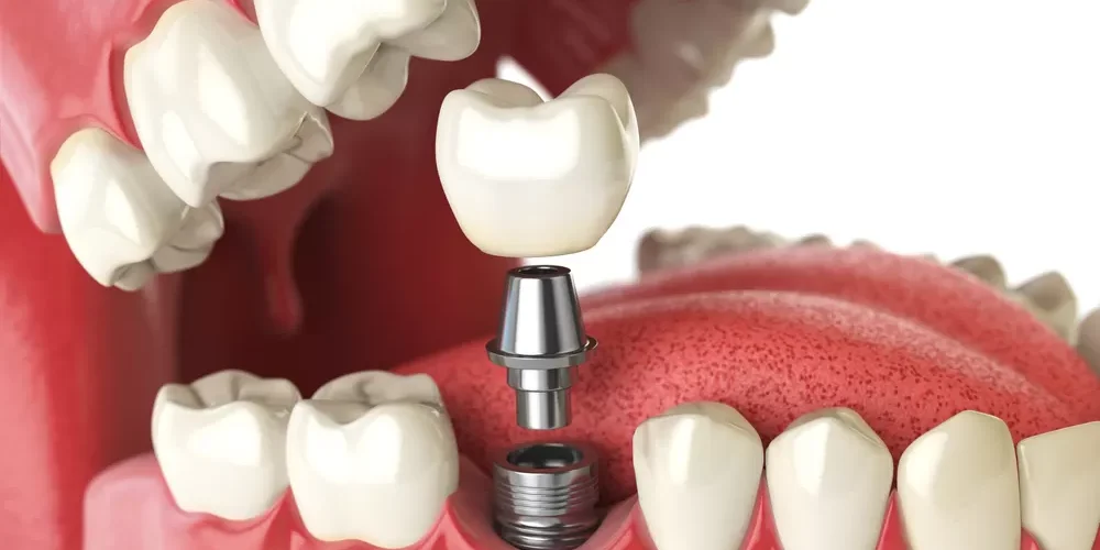 Exploring Types of Dental Implants and Their Benefits