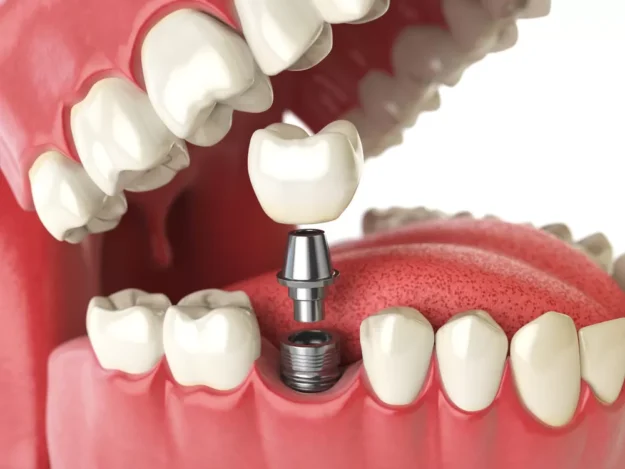 Exploring Types of Dental Implants and Their Benefits