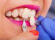 Exploring the Process of Getting Veneers