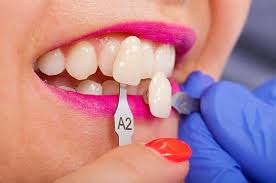 Exploring the Process of Getting Veneers