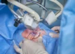 What To Expect Before, During, and After LASIK Surgery