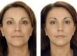 Exploring the Benefits of a Face Lift for Aging