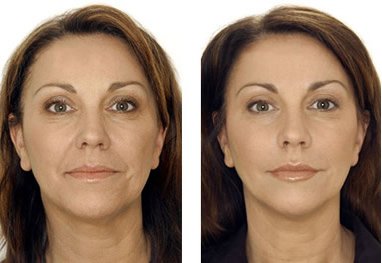 Exploring the Benefits of a Face Lift for Aging