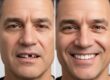 The Steps From Consultation to Recovery for All-on-6 Restorations