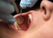 How To Spot Cracked Teeth Early for Effective Treatment