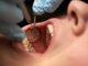 How To Spot Cracked Teeth Early for Effective Treatment