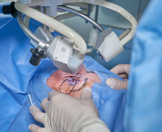The Advantages of LASIK Over Traditional Vision Correction Methods