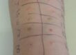 What You Need to Know About Allergy Testing