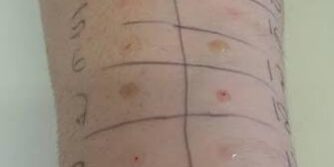 What You Need to Know About Allergy Testing What You Need to Know About Allergy Testing