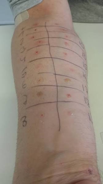 What You Need to Know About Allergy Testing What You Need to Know About Allergy Testing