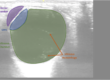 What are Emergency Procedures for Retinal Detachment