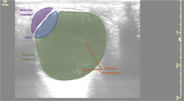 What are Emergency Procedures for Retinal Detachment