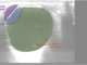 What are Emergency Procedures for Retinal Detachment
